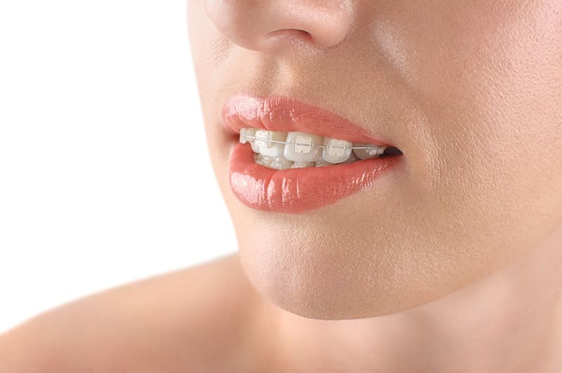 A close-up of a person's mouth and chin shows ceramic braces on their upper teeth, highlighting Stellar Orthodontics as an ideal option for clear braces in San Marcos, CA.