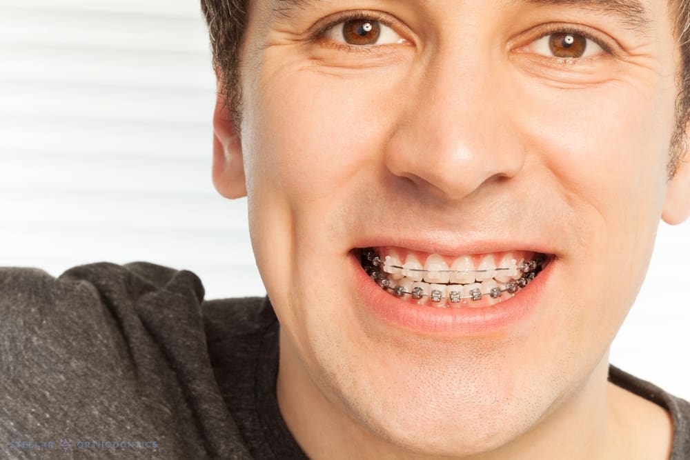 A smiling man with metal braces, dark shirt, light background; Stellar Orthodontics in San Marcos, CA treating overbite/underbite - Overbite vs Underbite in San Marcos, CA.