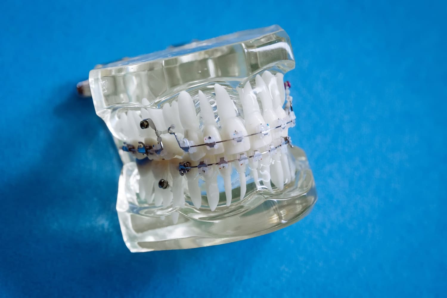 A dental model with metal braces displays upper and lower teeth against blue, representing Stellar Orthodontics in San Marcos, CA.